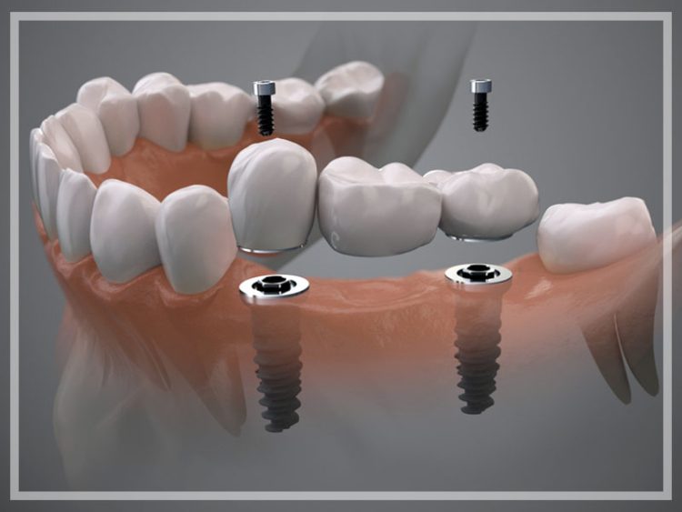 Implantat getragene Zahnbruecke