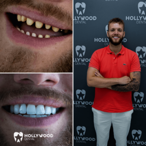 Before After Hollywood Dental 1