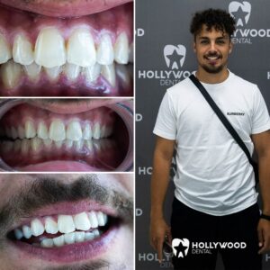 Before After Hollywood Dental 2