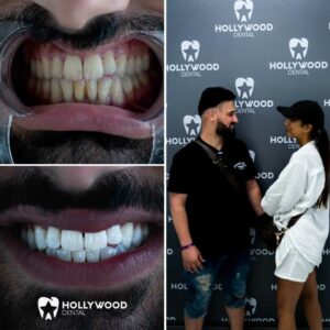 Before After Hollywood Dental 4