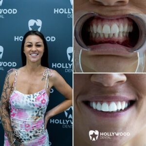Before After Hollywood Dental 5