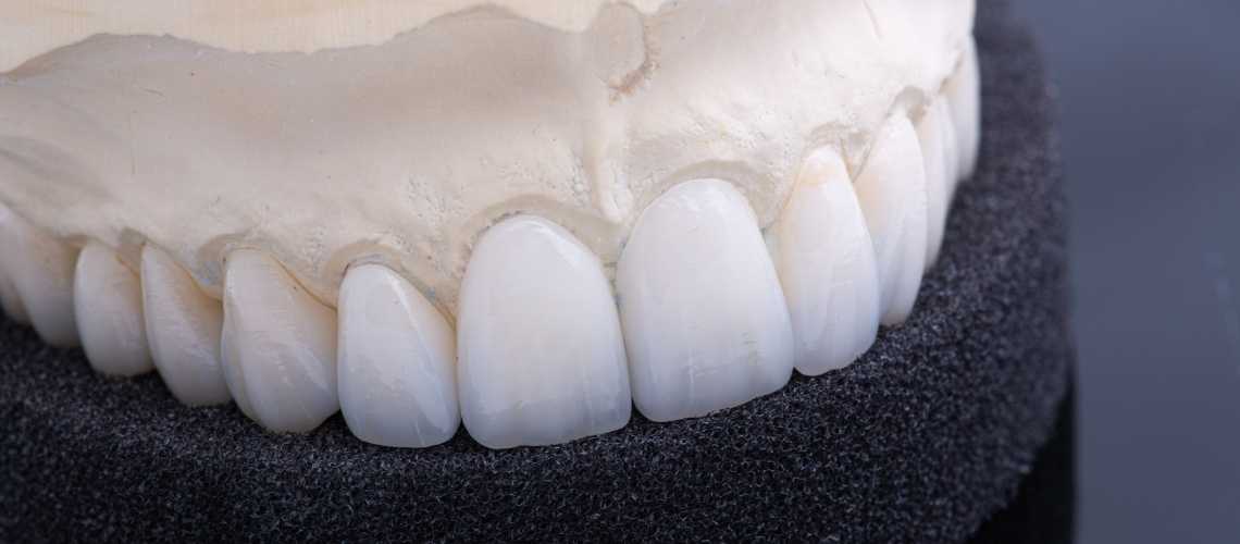 Unterschied zwischen Zahnkronen und EMAX Veneers