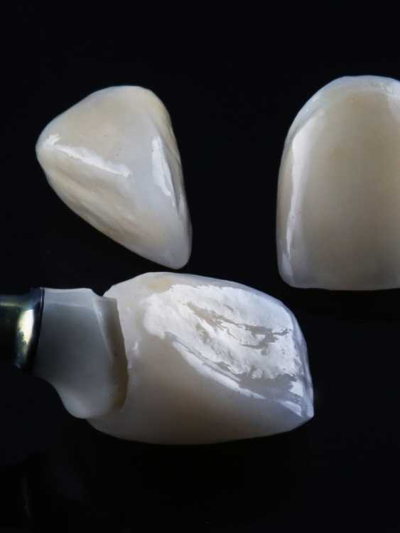 Zirkonium Veneers2