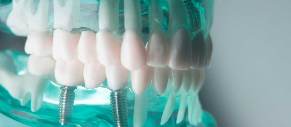 All-On-8-Zahnimplantat Kosten & Preise 2023