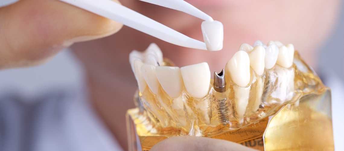 Erkrankungen im Zusammenhang mit Zahnimplantaten
