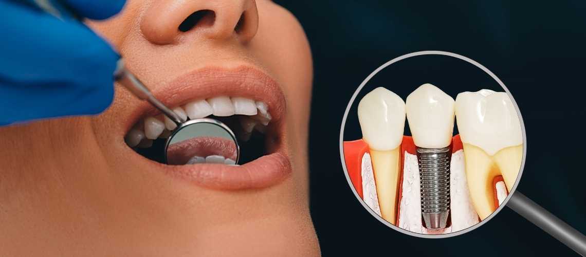 Implantat oder Brücke: Welcher Zahnersatz ist besser?