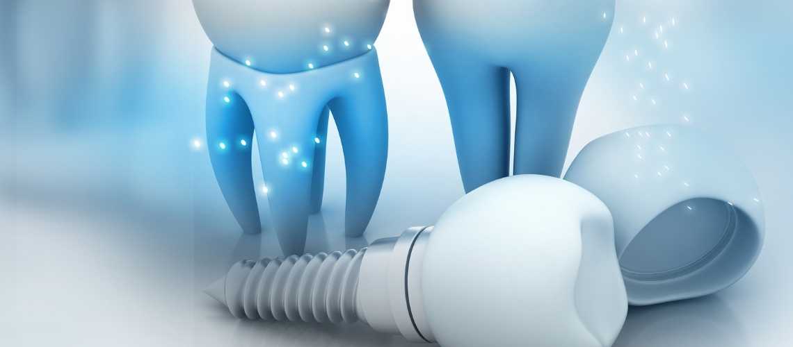 Implantatverlust: Wenn das Zahnimplantat nicht hält