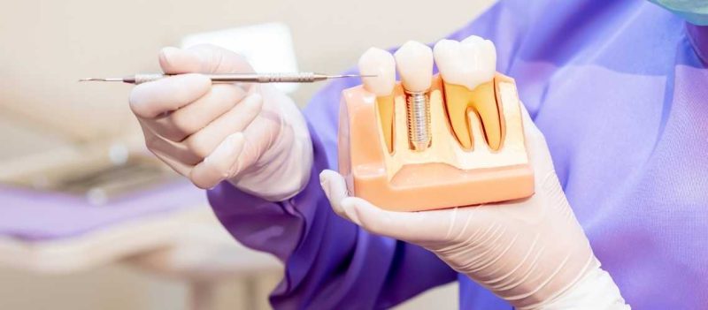 Wie lange kein Sport nach Zahnimplantat?