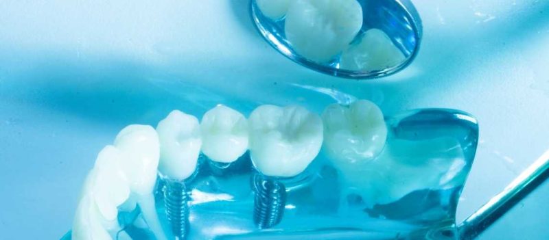 Zahnimplantat Schmerzen: Beschwerden nach Eingriff