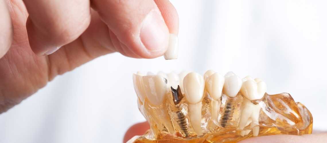 Zahnimplantate Risiken, Probleme & Gefahren