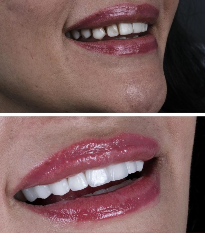 permanent dental veneers before and after