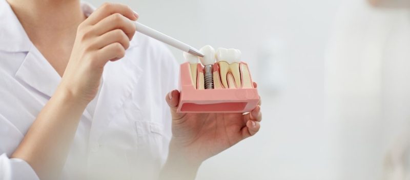 Zahnimplantate im Ausland: Sichere und kostengünstige Behandlung in der Türkei
