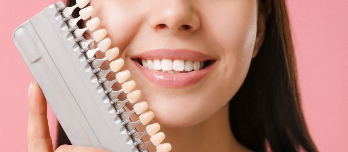 What Are the Different Types of Veneers