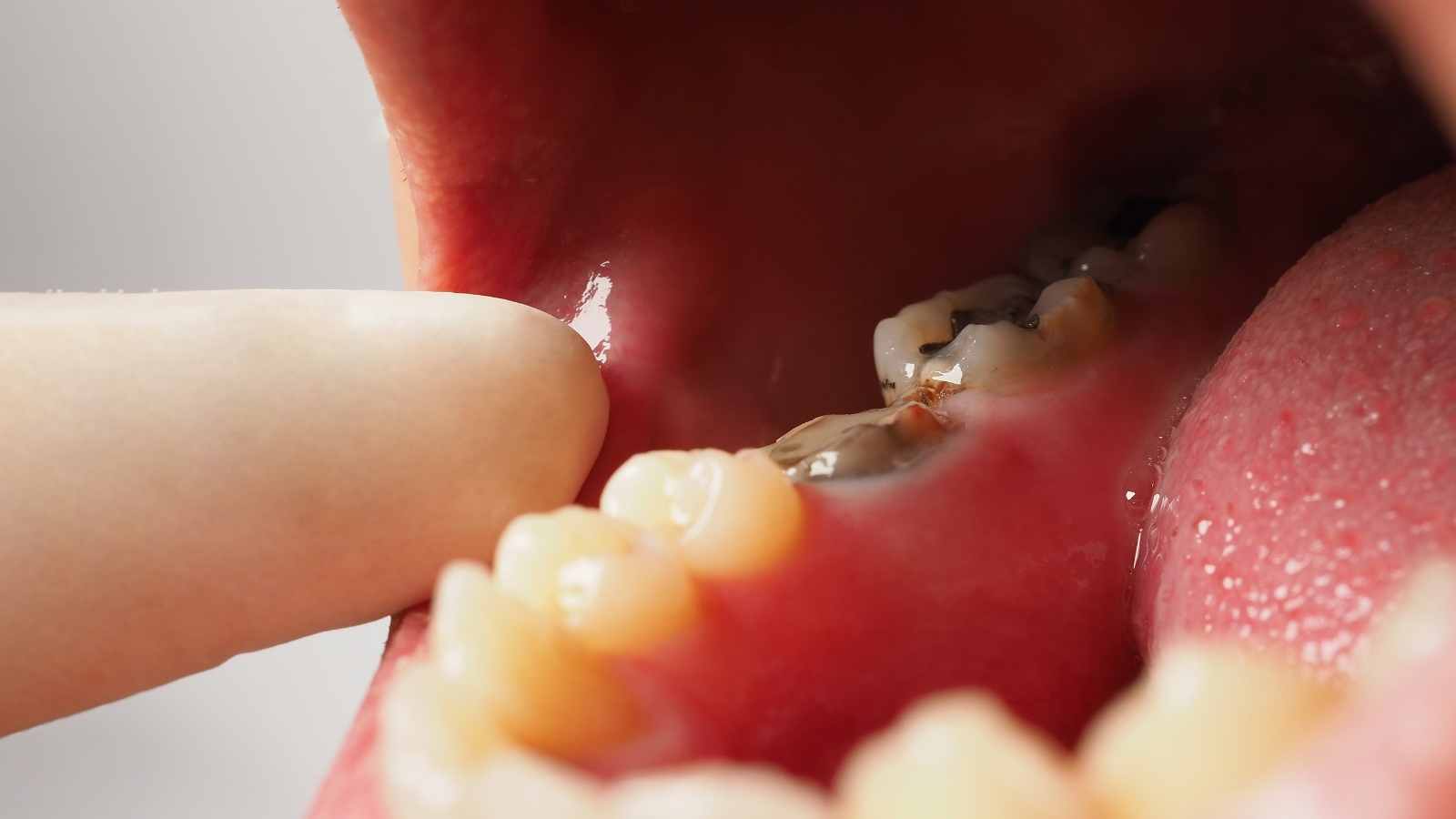 Wurzelkanalbehandlung bei verfallenem Zahn. Zahn oder Karies von Lowe