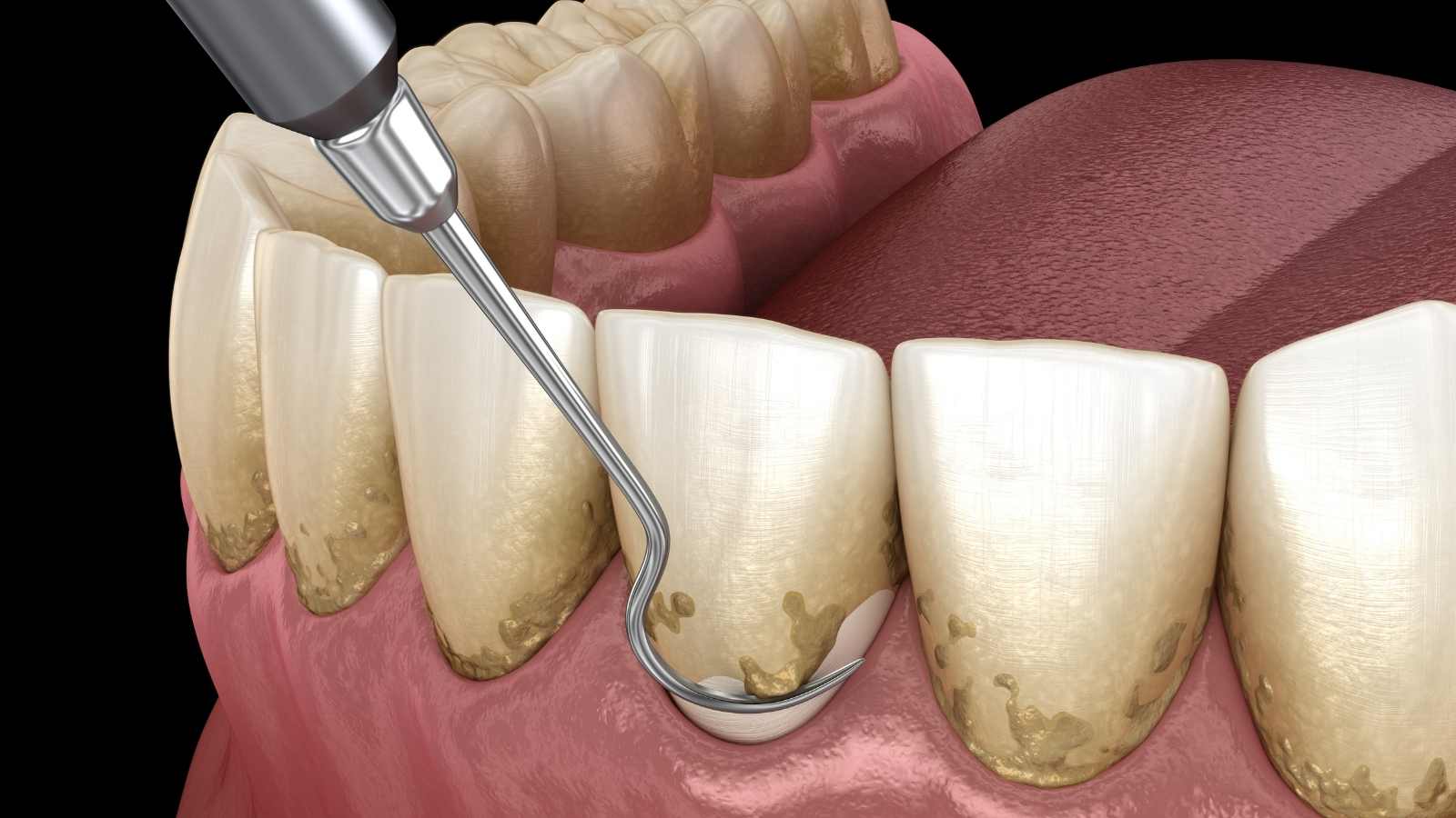 Ağız hijyeni_ Ölçekleme ve kök düzeltme (geleneksel periodontal tedavi). İnsan diş tedavisinin tıbbi açıdan doğru 3 boyutlu çizimi