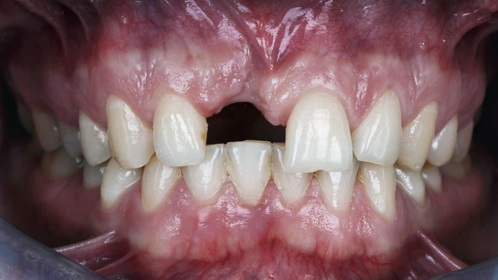 Diş kaybı ve dişsizlik sonrası çene kemiği erimesi