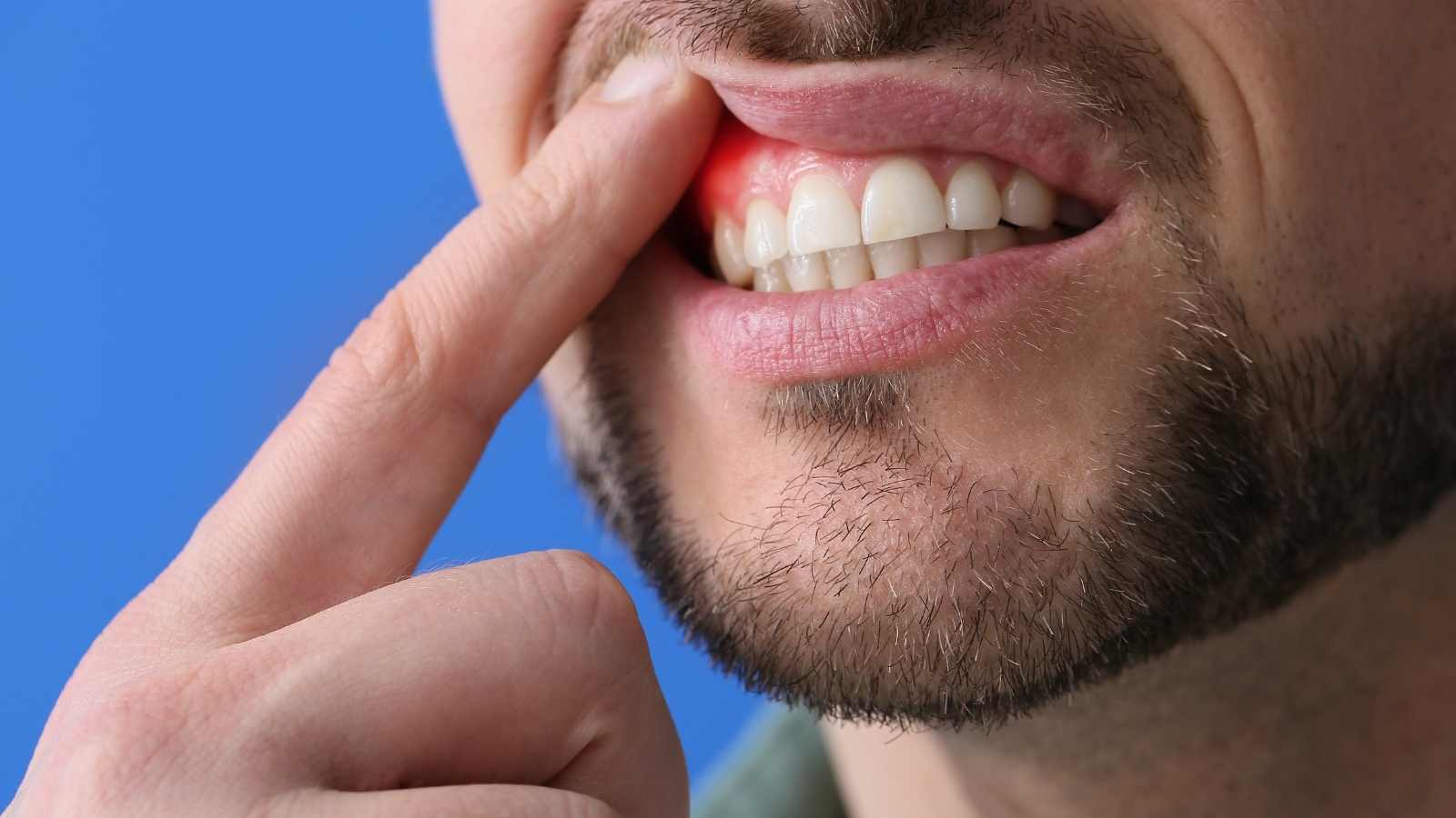 Diyabet Hastalarında İmplant Tedavisi irski olan diş eti kanaması