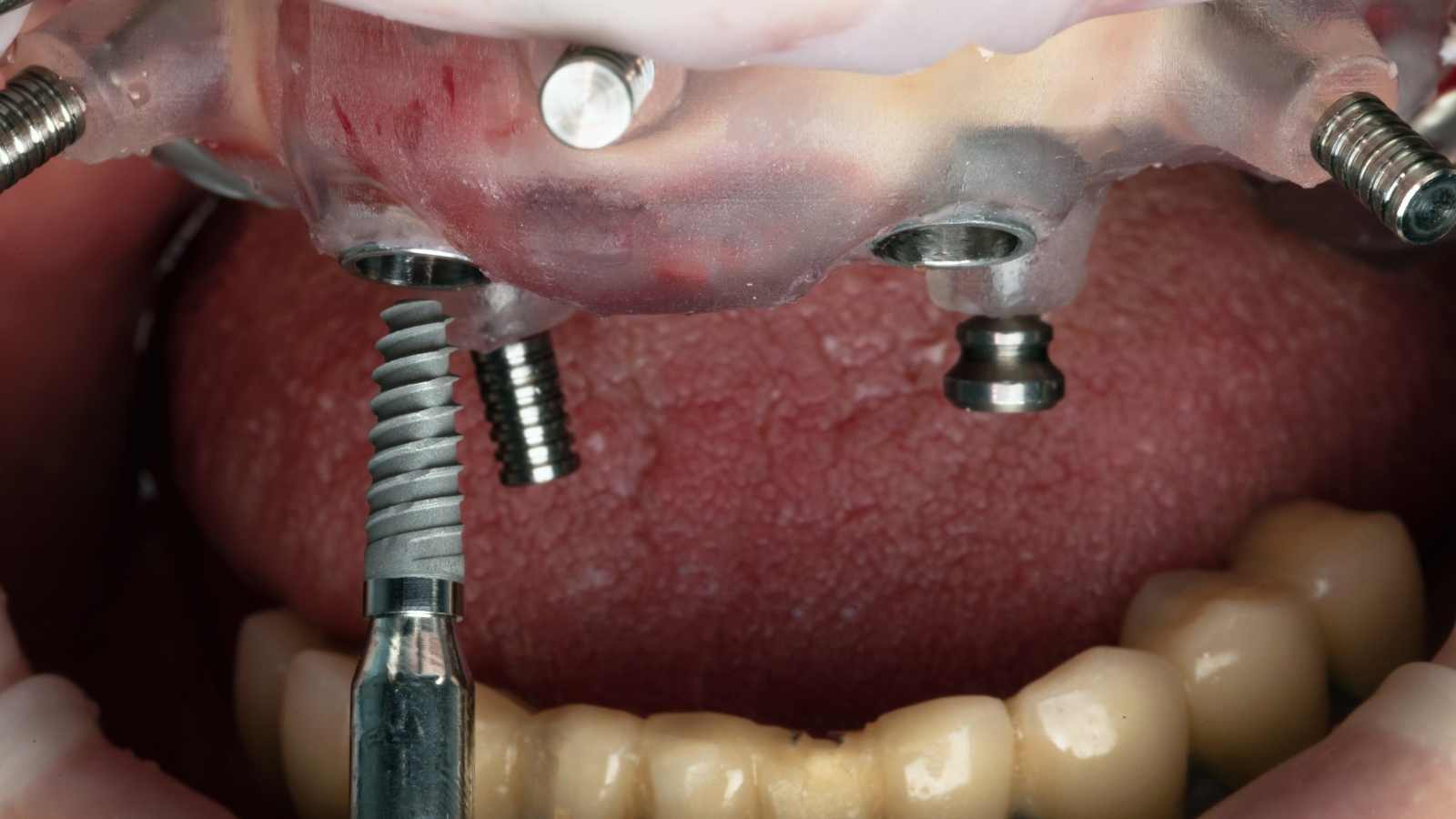 all on 4 diş implantı uygulaması