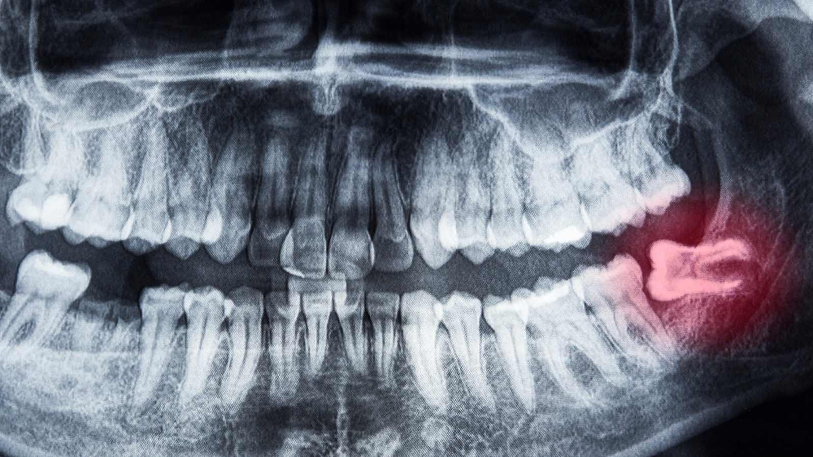 diş röntgeni ve 20 lik dişi⁠