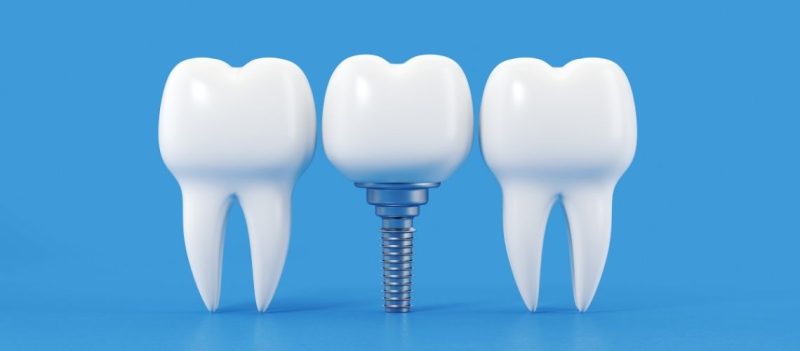 Dental Implants In Turkey Vs UK Why Turkey Is Cheaper