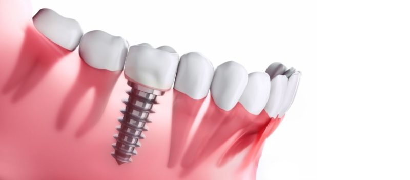 Destinations For Cheap Dental Implants In The World
