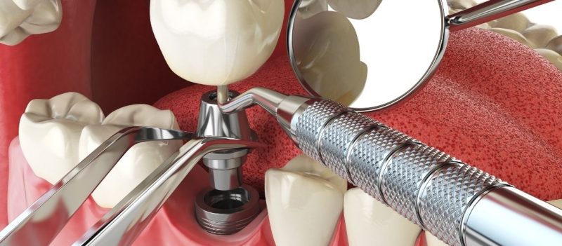Schmerzen beim Zahnimplantat wann sollten Sie zum Arzt