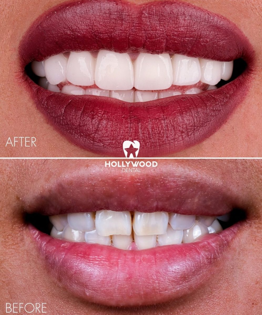 smile makeover mit veneers in der Turkei