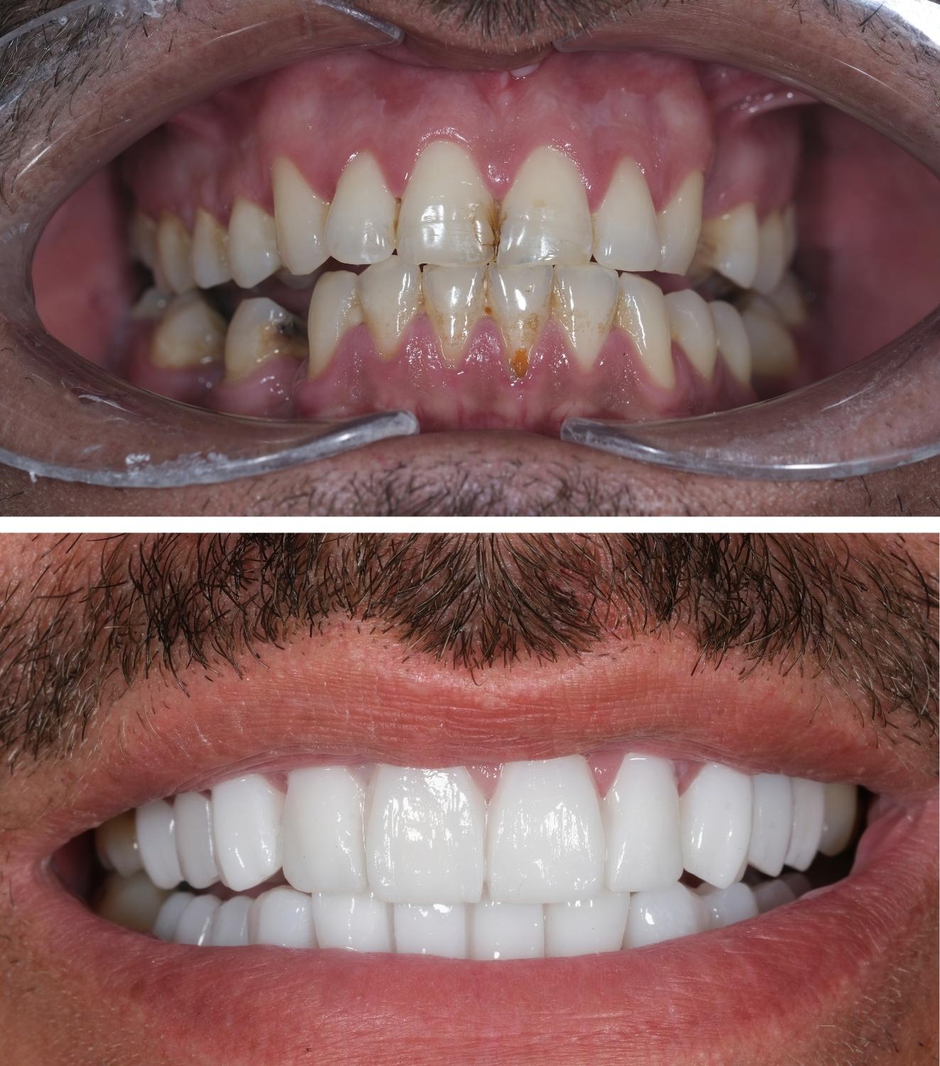 veneers before and after foto in turkey