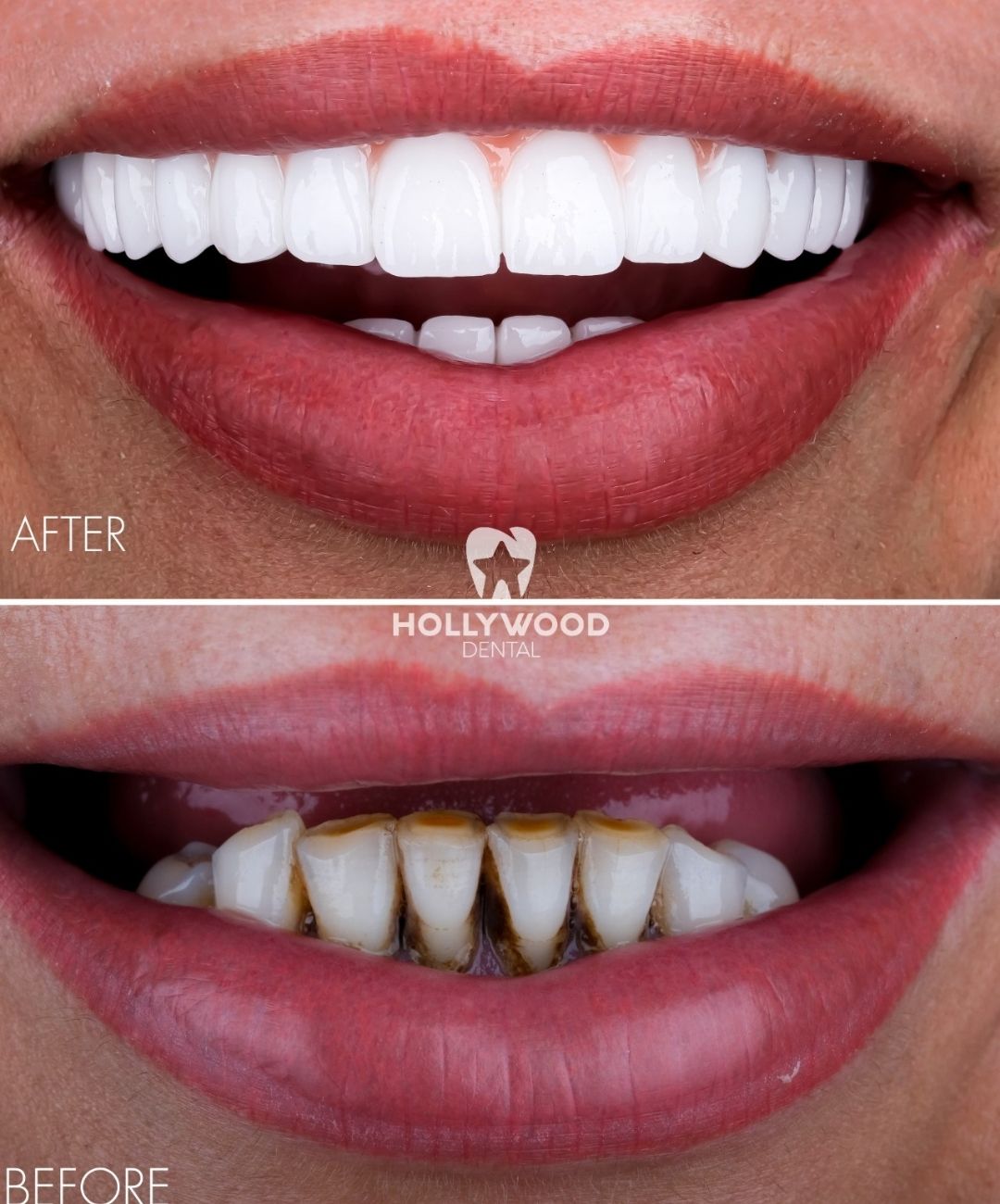 veneers before and after male in turkey